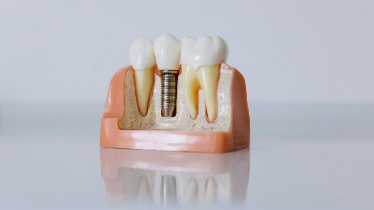 Dental Implants