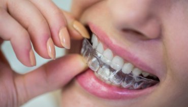 What are Clear Aligners? A quick guide to understand how they can perfect your smile.