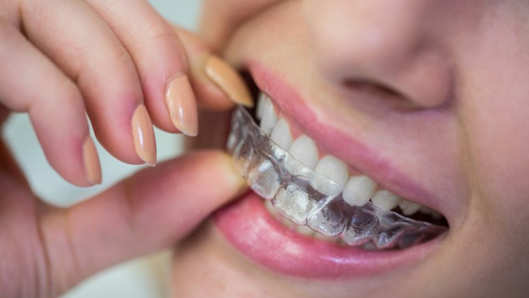 What are Clear Aligners? A quick guide to understand how they can perfect your smile.
