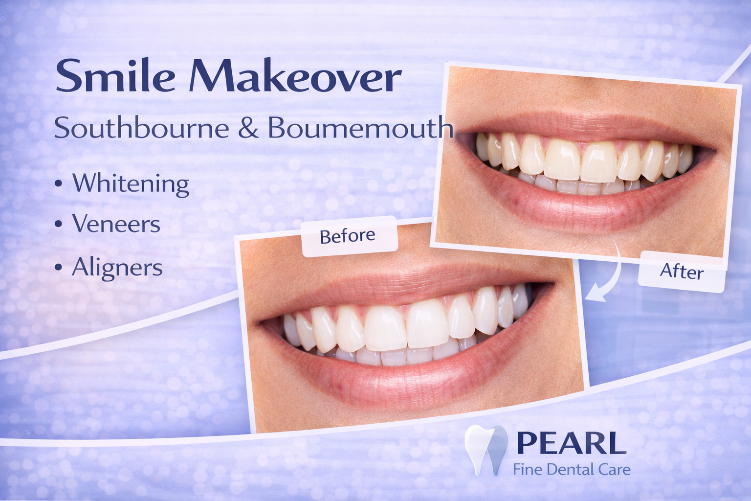 Smile makeover Southbourne Bournemouth showing before and after dental transformation with whitening, veneers and straightened teeth at Pearl Fine Dental Care.